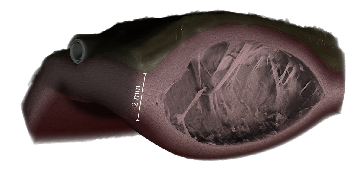 In-situ visualization of a dissected porcine aorta after intramural injection under synchrotron X-ray computed tomography. Credit: Baptiste Pierrat, Cristina Cavinato, Mathieu Simon, image acquired on the ANATOMIX beamline at synchrotron SOLEIL